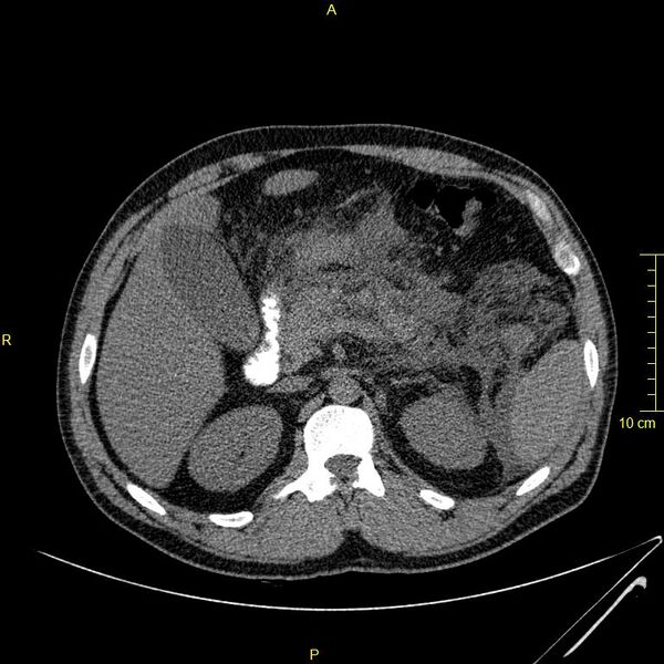 File:Acute pancreatitis (Radiopaedia 23231-23290 Axial oral contrast 44).JPG