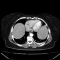 Acute pancreatitis - Balthazar C (Radiopaedia 26569-26714 Axial C+ arterial phase 7).jpg