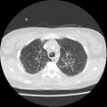 Acute pulmonary edema on CT (Radiopaedia 33582-34672 Axial lung window 11).jpg