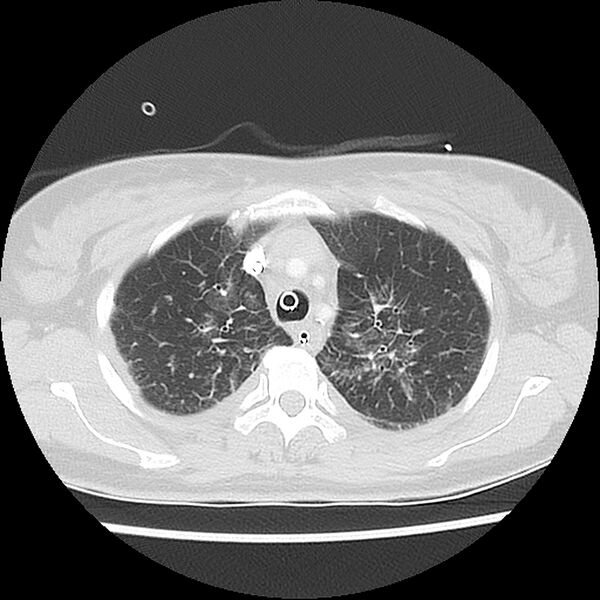 File:Acute pulmonary edema on CT (Radiopaedia 33582-34672 Axial lung window 11).jpg