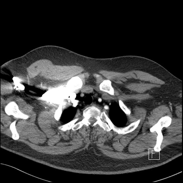 File:Acute pulmonary embolism with pulmonary infarct (Radiopaedia 73062-83768 Axial C+ CTPA 3).jpg
