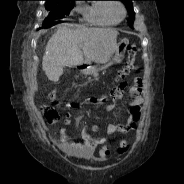 File:Acute tubular necrosis (Radiopaedia 28077-28334 G 28).jpg