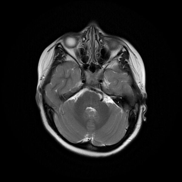 File:Adamantinomatous craniopharyngioma (Radiopaedia 77407-89529 Axial T2 7).jpg