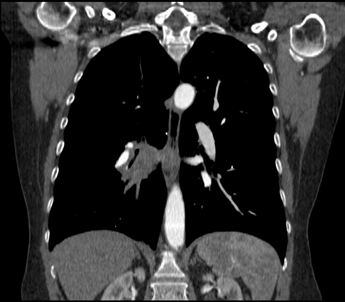 File:Adenocarcinoma of the lung (Radiopaedia 44205-47803 Coronal C+ portal venous phase 57).jpg
