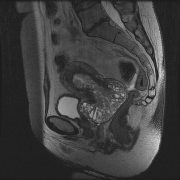 File:Adenoma malignum of the cervix (Radiopaedia 24460-24765 T2 59).jpg