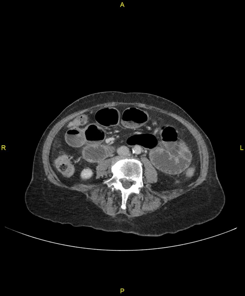 Adhesional small bowel obstruction (Radiopaedia 85402-101024 Axial C+ portal venous phase 159).jpg