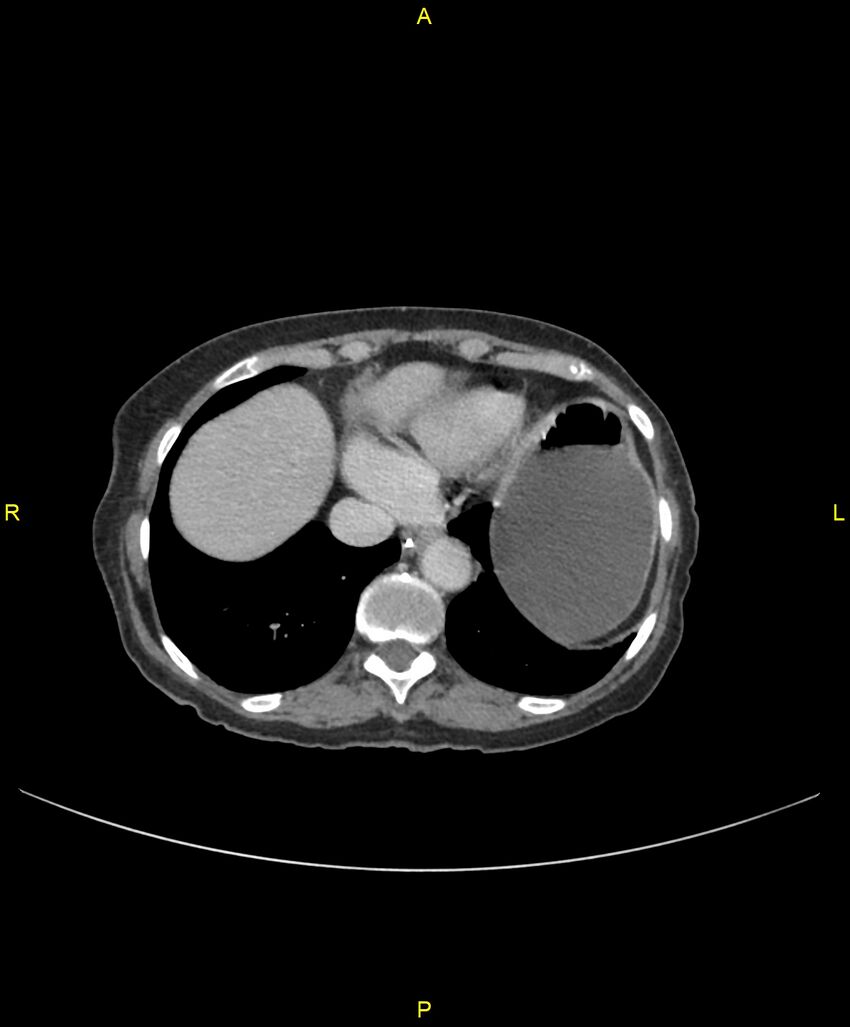 Adhesional small bowel obstruction (Radiopaedia 85402-101024 Axial C+ portal venous phase 29).jpg