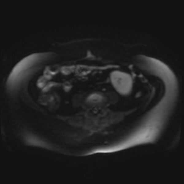 File:Adrenal cortical carcinoma (Radiopaedia 70906-81116 Axial DWI 25).jpg