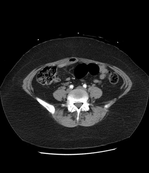 File:Adrenal cortical carcinoma with IVC invasion and thrombosis (Radiopaedia 34307-35597 Axial C+ arterial phase 59).jpg