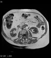 Adrenal myelolipoma (Radiopaedia 6765-7961 Axial T1 in-phase 33).jpg