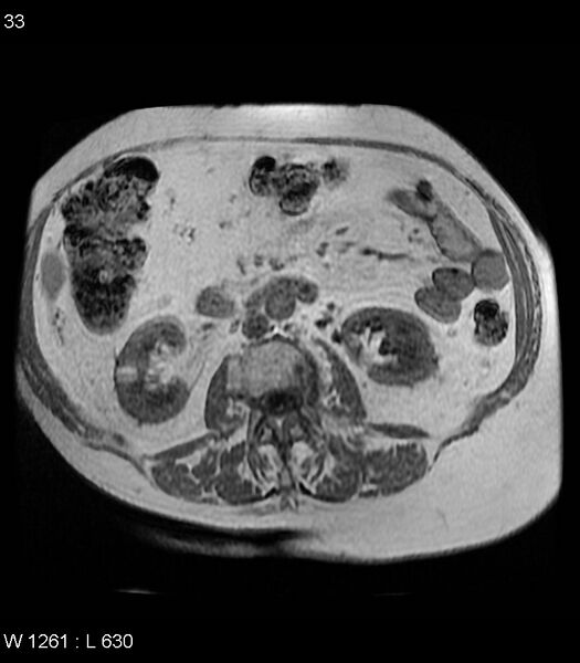 File:Adrenal myelolipoma (Radiopaedia 6765-7961 Axial T1 in-phase 33).jpg