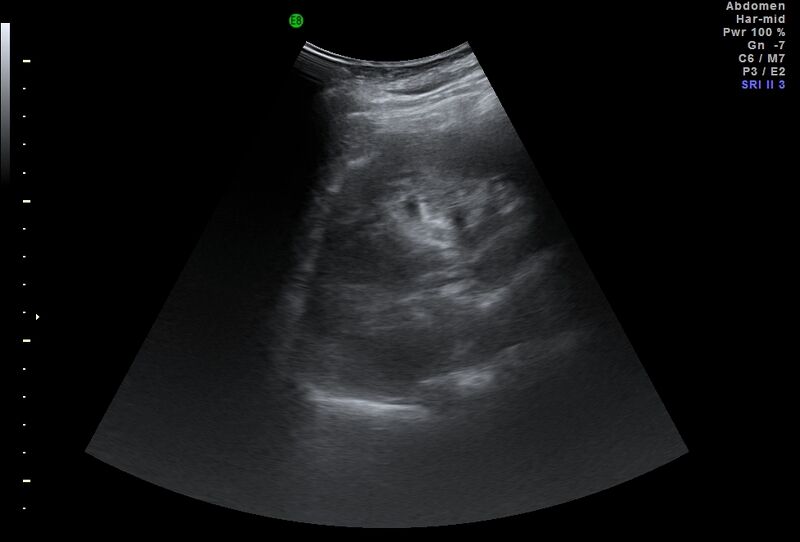 File:Adrenal myelolipoma - bilateral (Radiopaedia 74805-85811 Abdominal ultrasound 14).jpg
