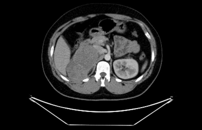 File:Adrenocortical carcinoma (Radiopaedia 80134-93438 Axial C+ portal venous phase 47).jpg