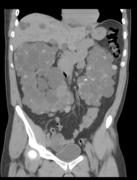 File:Adult polycystic kidney disease (Radiopaedia 47866-52626 Coronal non-contrast 19).png