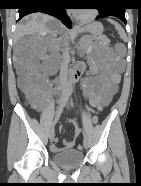 File:Adult polycystic kidney disease (Radiopaedia 47866-52626 Coronal non-contrast 24).png