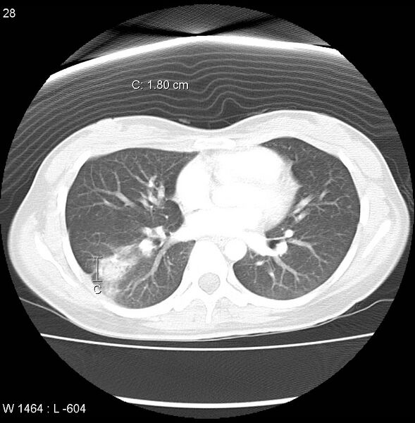 File:Air crescent sign (aspergilloma) (Radiopaedia 14380-14306 Axial lung window 10).jpg