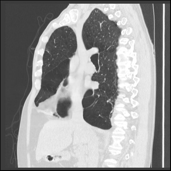 File:Alpha-1-antitrypsin deficiency (Radiopaedia 40993-43722 Sagittal lung window 152).jpg