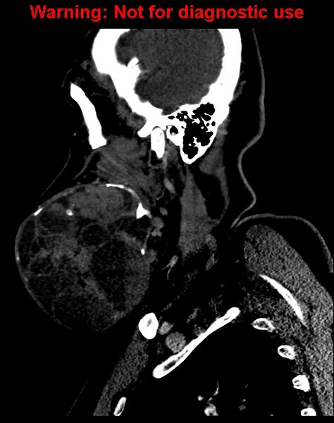 File:Ameloblastoma (Radiopaedia 33126-34164 F 17).jpg
