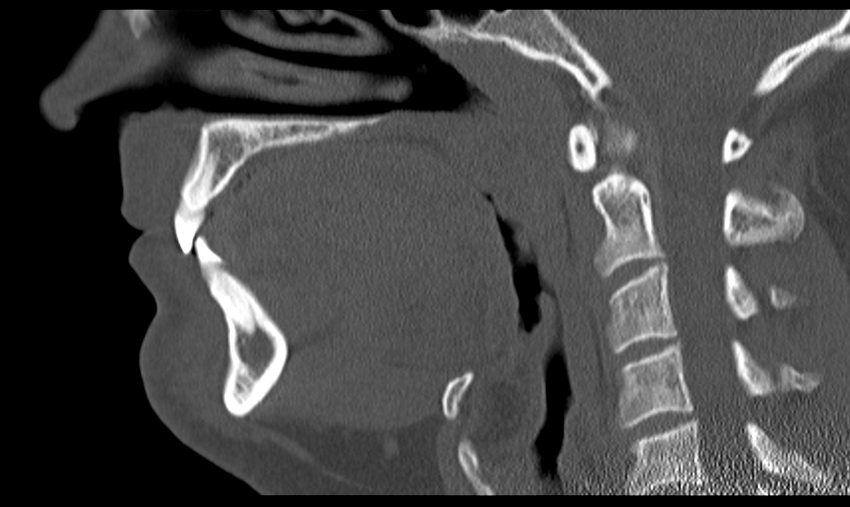Ameloblastoma (Radiopaedia 33677-34806 Sagittal bone window 31).png
