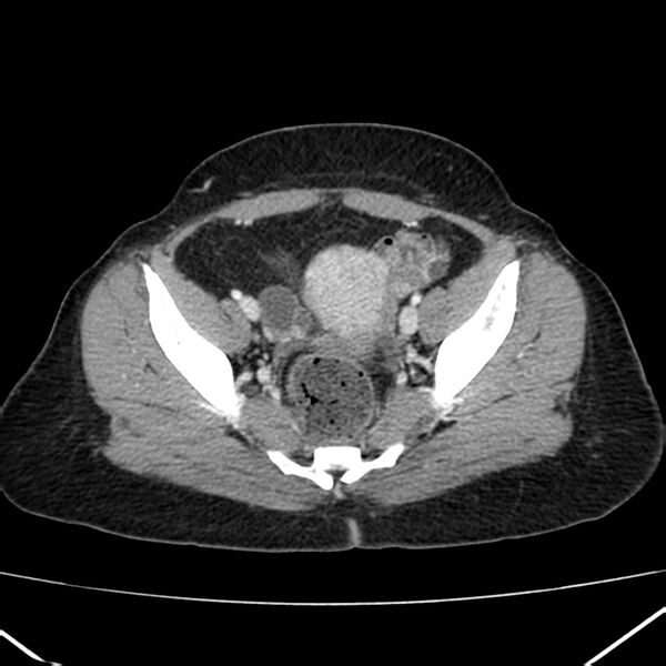 File:Ampullary tumor (Radiopaedia 22787-22816 C 58).jpg