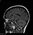 Amyotrophic lateral sclerosis (Radiopaedia 5373-7134 Sagittal FLAIR 17).jpg