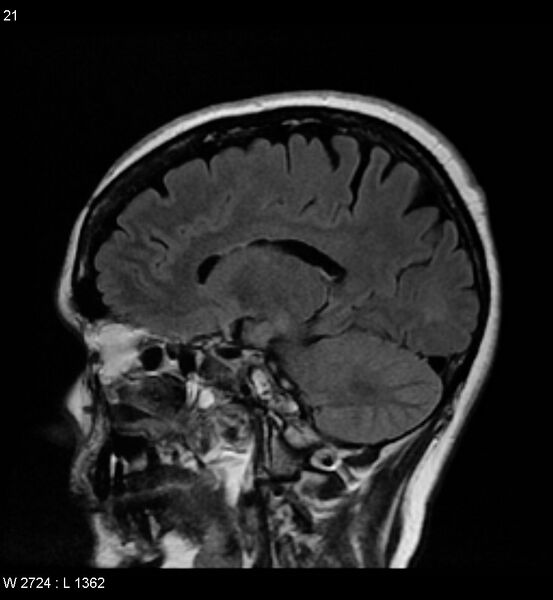 File:Amyotrophic lateral sclerosis (Radiopaedia 5373-7134 Sagittal FLAIR 17).jpg