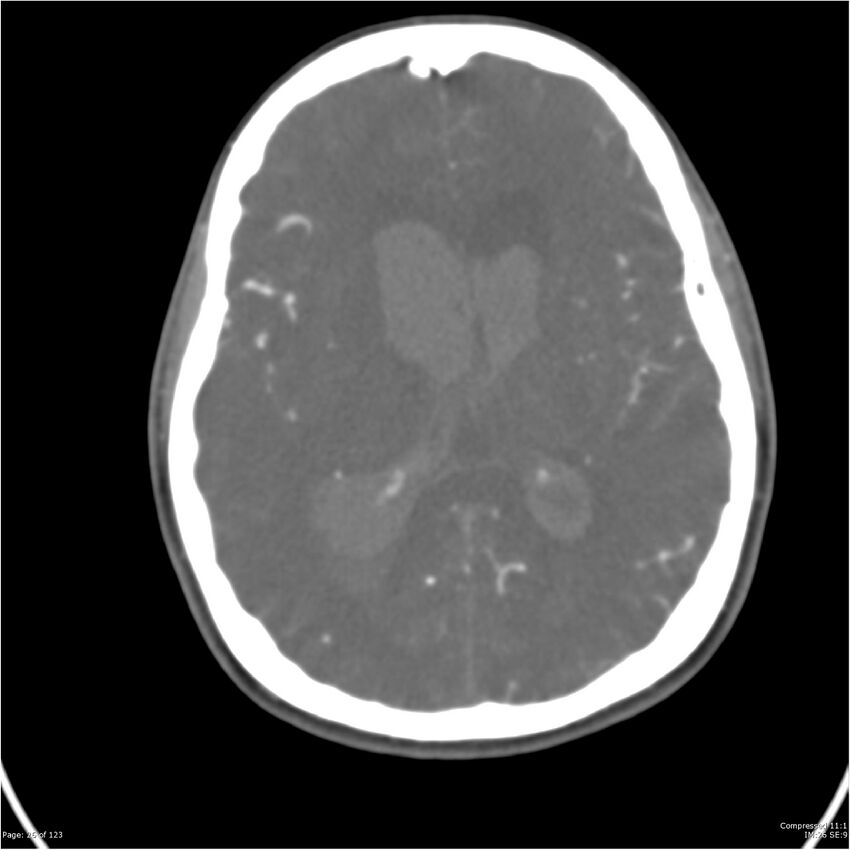 Aneurysmal subarachnoid hemorrhage and Moya Moya disease (Radiopaedia 34306-35593 Axial CT COW 26).jpg