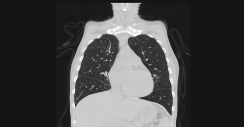 File:Angioinvasive aspergellosis (Radiopaedia 66995-76315 Coronal lung window 22).jpg
