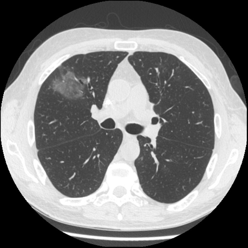 Angioinvasive aspergillosis (Radiopaedia 43957-47466 Axial lung window 30).jpg