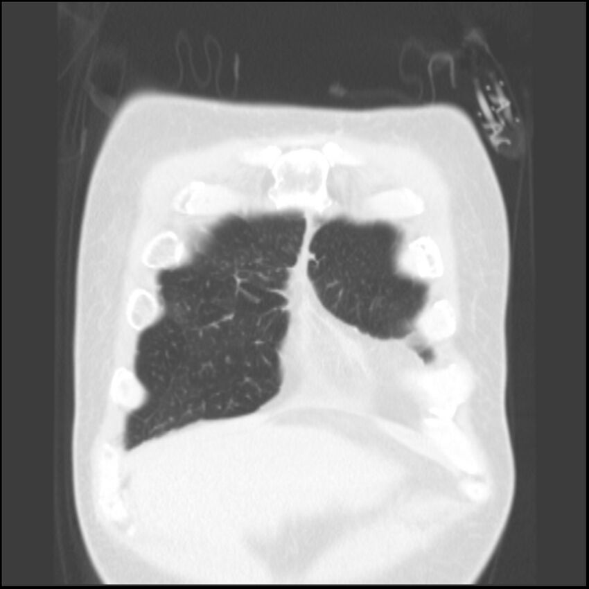 Angioinvasive aspergillosis (Radiopaedia 43957-47466 Coronal lung window 82).jpg
