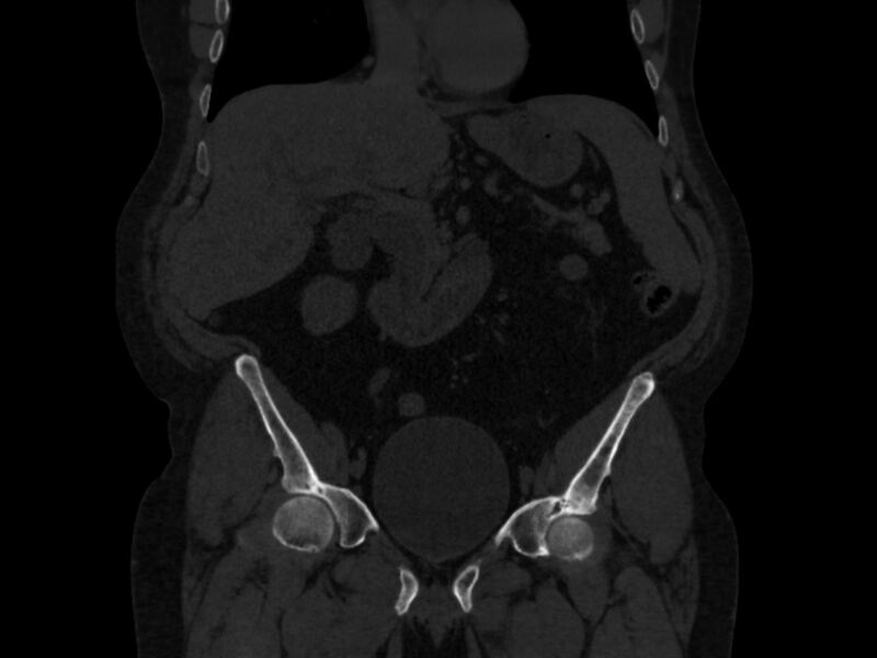 File:Ankylosing spondylitis (Radiopaedia 44609-48357 Coronal bone window 15).jpg