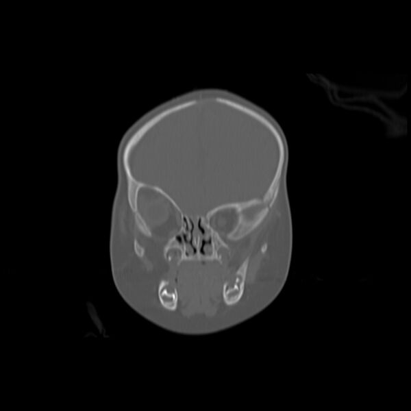 File:Anterior plagiocephaly (Radiopaedia 71836-82273 Coronal bone window 10).jpg