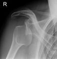 Anterior shoulder dislocation (Radiopaedia 7958-8807 B 1).jpg