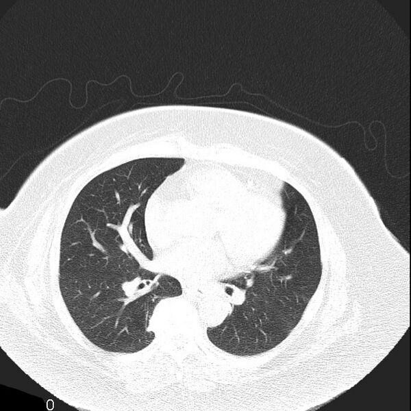 File:Aortic arch false aneurysm (Radiopaedia 14667-14587 Axial lung window 14).jpg
