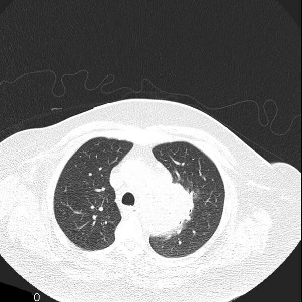 File:Aortic arch false aneurysm (Radiopaedia 14667-14587 Axial lung window 8).jpg