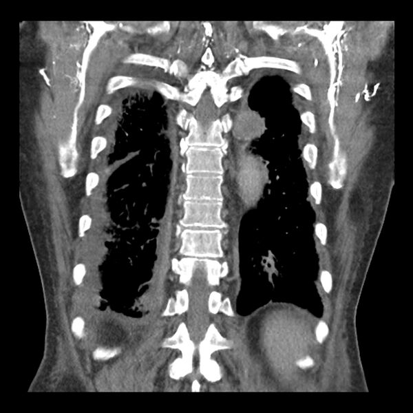 File:Aortic arch graft infection (FDG PET-CT) (Radiopaedia 71975-82437 Coronal 49).jpg