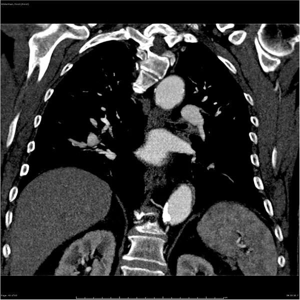 File:Aortic dissection - Stanford type A (Radiopaedia 26183-26315 A 45).jpg