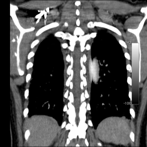 File:Aortic dissection - Stanford type A (Radiopaedia 29247-29659 B 49).jpg