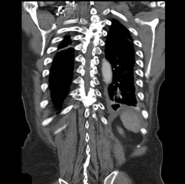 File:Aortic dissection with rupture into pericardium (Radiopaedia 12384-12647 B 38).jpg