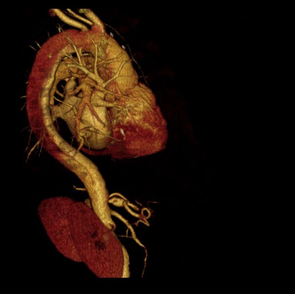 File:Aortic dissection with rupture into pericardium (Radiopaedia 12384-12647 D 12).jpg