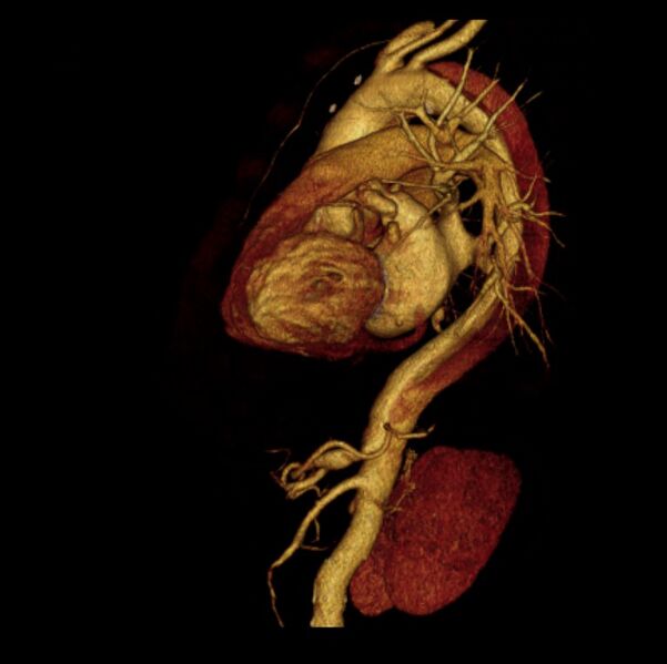 File:Aortic dissection with rupture into pericardium (Radiopaedia 12384-12647 D 29).jpg