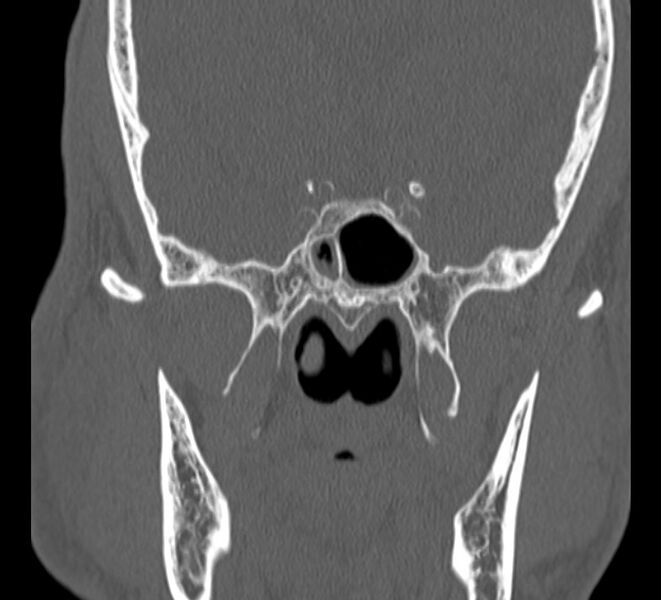 File:Aplastic maxillary sinuses (Radiopaedia 60030-67561 Coronal non-contrast 33).jpg