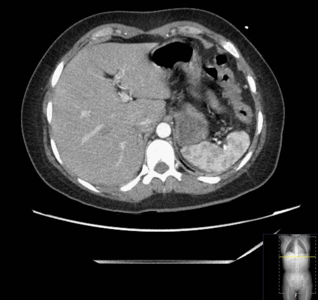 File:Appendicitis (CT angiogram) (Radiopaedia 154713-127660 Axial 159).jpg