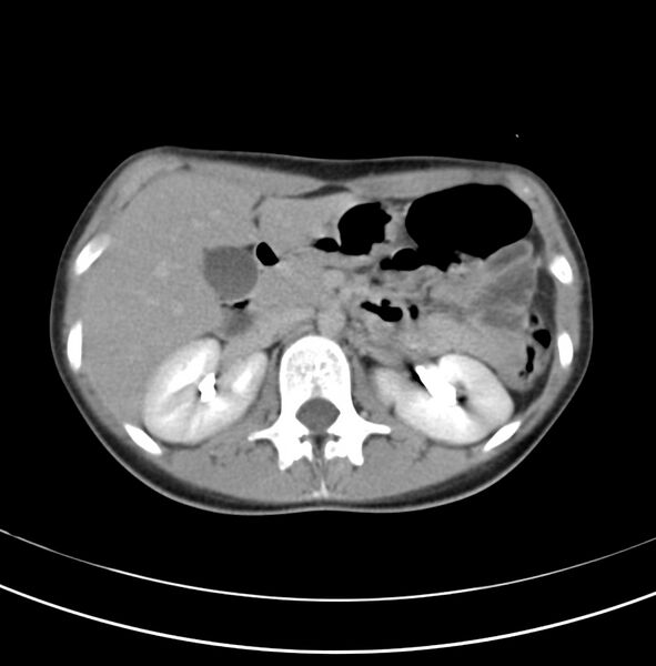 File:Appendicitis and incidental bicornuate uterus (Radiopaedia 22833-22853 Axial C+ delayed 9).jpg
