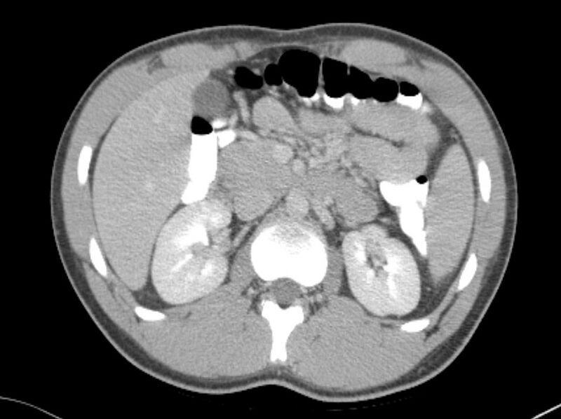 File:Appendicitis and incidental foregut duplication cyst (Radiopaedia 52962-58916 A 15).jpg