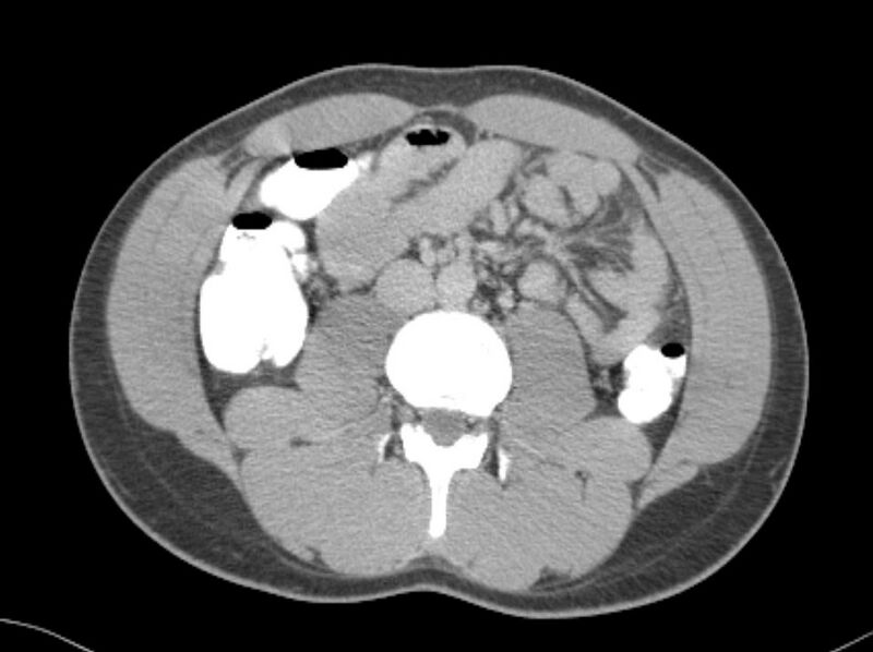 File:Appendicitis and incidental foregut duplication cyst (Radiopaedia 52962-58916 A 36).jpg