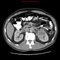 Appendicitis and renal cell carcinoma (Radiopaedia 17063-16760 A 21).jpg