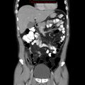 Appendicitis and renal cell carcinoma (Radiopaedia 17063-16760 B 11).jpg