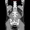 Appendicitis and renal cell carcinoma (Radiopaedia 17063-16760 B 25).jpg