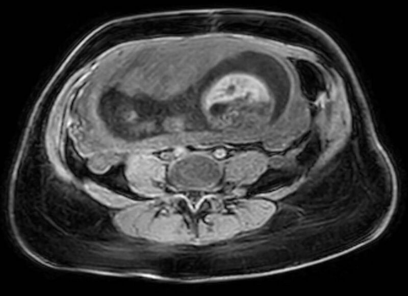 File:Appendicitis in gravida (MRI) (Radiopaedia 89433-106395 Axial DIXON 90).jpg